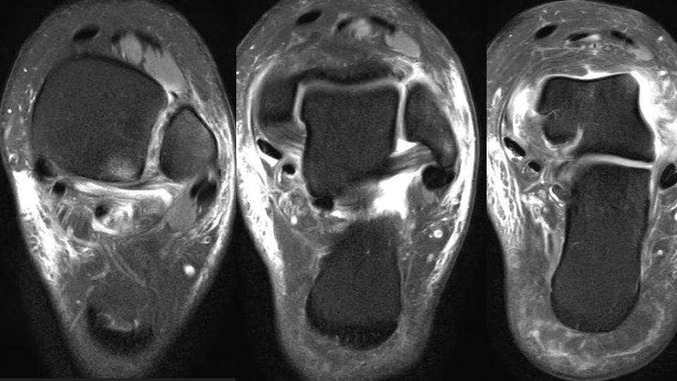 Figure 3 for case syndesmosis ( RID6088 )